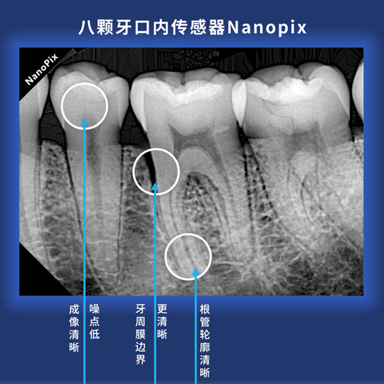 NanoPix 將根管輪廓和牙周膜邊界都開(kāi)到HD高清模式